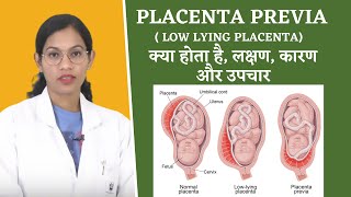 Placenta Previa FAQs By Dr Richa Vaishnav [upl. by Glogau123]