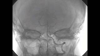 Selective Intraarterial Thrombolysis for Cardioembolic Stroke [upl. by Miof Mela]