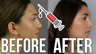 Nose Job Experience  My Rhinoplasty  Plastic Surgery Story [upl. by Mosera]