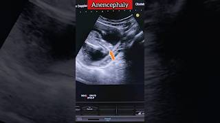 Anomaly Scan Anencephaly ❤️💯 medical anomaly ultrasound pregnancy shorts [upl. by Dorlisa]