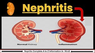 Nephritis in Hindi  Causes Symptoms amp Treatment  Nephrotic Syndrome  Nursing lecture [upl. by Desmond]