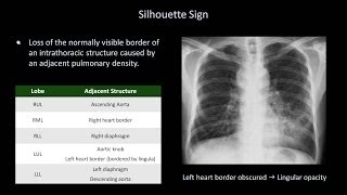 How to Interpret a Chest XRay Lesson 8  Focal Lung Processes [upl. by Epoh502]