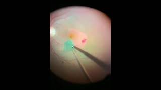 Dr Skaf Repairing a Macular Hole in the Retina [upl. by Alit]