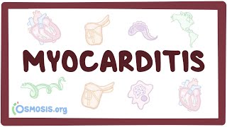 Myocarditis  causes symptoms diagnosis treatment pathology [upl. by Felty306]