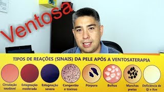 Ventosa Mini Curso de Ventosaterapia  Parte 22 [upl. by Akkeber435]