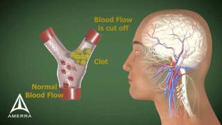 Stroke  3D Medical Animation [upl. by Nivlag]