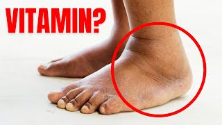 1 Vitamin to Eliminate Swelling in Feet and Legs [upl. by Aimaj]