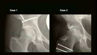 K Siebenrock Acetabular retroversion PAO versus surgical hip dislocation Hip Symposium 2016 [upl. by Lalat404]