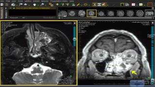 Inverting Papilloma or Squamous Cell Carcinoma [upl. by Neelahtak]