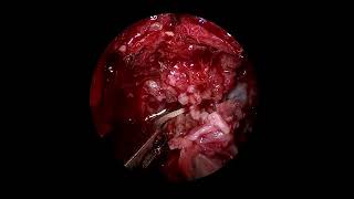 Endoscopic endonasal ethmoidal craniectomy and reconstruction [upl. by Bowra517]