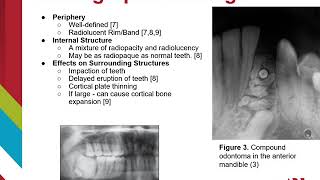 Odontoma [upl. by Mario]