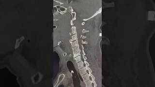 Ct Scan Showing Multiple Cervical Fractures ctscan radiology [upl. by Htaek]