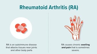 rheumatoid arthritis homeopathymedicine [upl. by Adaiha]