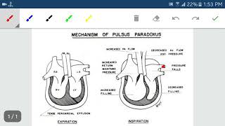 Pulsus paradoxus [upl. by Fisk]