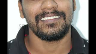 Teeth Gap Closure In Chennai  Affordable Self Ligating Braces Treatement  DrMKP Invisalign Clinic [upl. by Jerome]