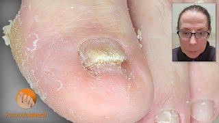 Frequent case of onychomycosis with comments  Toenail cleaning  Podological treatment [upl. by Nico303]