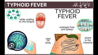 typhoid fever  typhaed bakhar  टाइफाइड बुखार [upl. by Latsyrk]