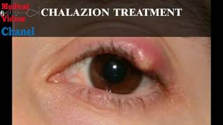 How To Get Rid Of Chalazion  Best Medical Videos [upl. by Sassan]