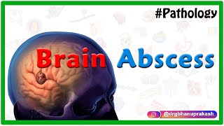 Brain abscess Pathology  Etiology  Pathogenesis  Clinical manifestations  Diagnosis amp Treatment [upl. by Aid]