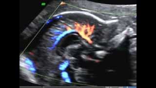 ISUOG How to image the fetal corpus callosum course of the pericallosal artery [upl. by Lemmy]