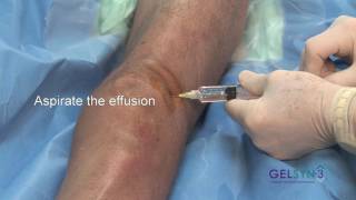 Superior Lateral Extended Knee GELSYN3 [upl. by Ullund]