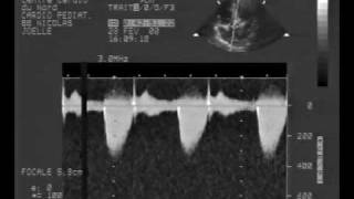 echocardiogrammultiple rhabdomyoma tumor cw doppler [upl. by Ahsinhoj]