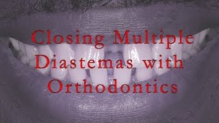 Closing Multiple Diastemas With Orthodontics [upl. by Leryt303]