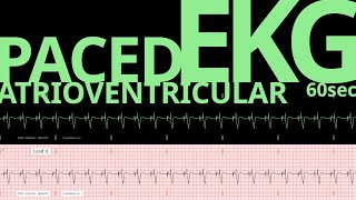 EKG ECG  Atrioventricular Pacemaker HR68 [upl. by Deloris]