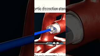 👉Motivation 🙏Neet study🫡 Aortic Dissection Stend Grafting 🖊️🖊️ [upl. by Udela]