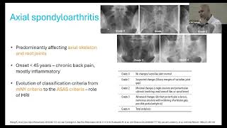 SPONDYLOARTHRITIS  APPROACH AND MANAGEMENT  DR ASHISH J MATHEW RHEUMATOLOGY [upl. by Ativet]