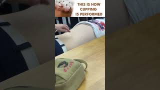 How Cupping is performed [upl. by Anihpesoj]