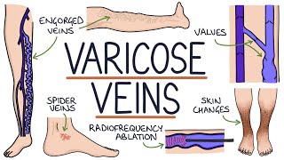 Understanding Varicose Veins [upl. by Adiaj]