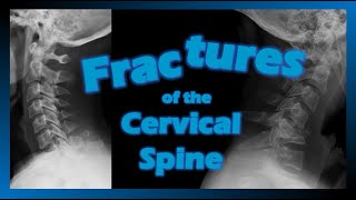 Fractures of the Cervical Spine fracture trauma cervical [upl. by Tigges550]