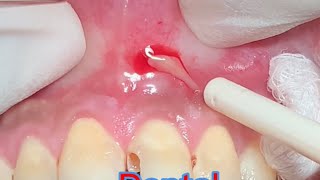 Dental Abscess Drainage [upl. by Eiral622]