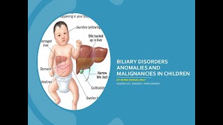 Biliary Disorders Anomalies and malignancies in children [upl. by Jabez158]