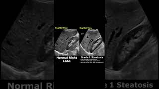 Fatty Liver Grading On Ultrasound  Hepatic Steatosis Grades 123  Normal Vs Abnormal USG shorts [upl. by Tandy299]