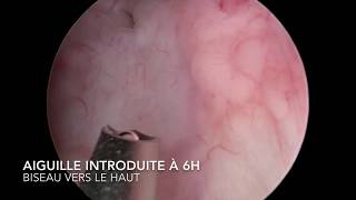 chirurgie endoscopique  injection defluxmacroplastique dans le cadre dun reflux vésico urétéral [upl. by Ahsetel419]