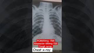 chest xray pneumonia pneumonia treatment medical doctors youtubeshorts [upl. by Attirb]