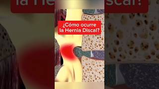 Hernia Discal Lumbar 💥 Dolor Lumbar DolorLumbar dolordeespalda Ejercicios shorts [upl. by Gneh]