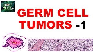 OVARIAN TUMORS  Part 4 Germ cell tumors Dysgerminoma yolk sac tumor  Pathology [upl. by Matejka]