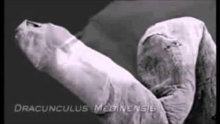 Dracunculus medinensis Parasitology Video [upl. by Lleret148]