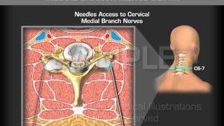 Image Guide Cervical Medial Branch Nerve Block [upl. by Thacher]