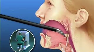 Tongue Cancer surgery 3D Animation video by medicalhelp50 [upl. by Einnahc]