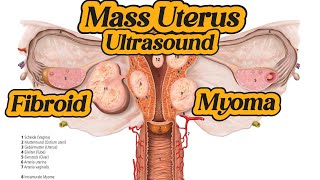 Uterus  Fibroid  Myoma  Mass On Ultrasound [upl. by Tiga935]