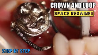 Crown and Loop Space Regainer  step by step [upl. by Ardith]