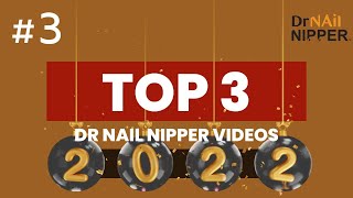 Best of 2022 Dr Nail Nipper Videos 3  Old Nail on Top of New Toenail [upl. by Bourne778]