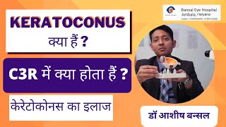 What is Keratoconus amp C3R Corneal Cross Linking Treatment  केरेटोकोनस का इलाज In Hindi [upl. by Deirdre960]