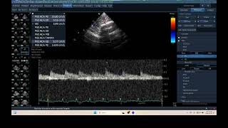 IQ 298 TCD BRAIN ULTRASOUND ECHOPAC ANALYSIS 1 [upl. by Greiner]