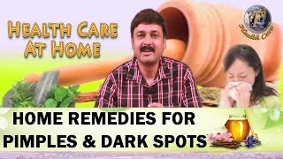 HOME REMEDIES FOR PIMPLES ACNE AND DARK SPOTSII कील मुहासों और काले धब्बो का घरेलू उपचार II [upl. by Ignacia]