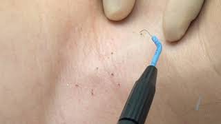 Skin Tag Removal at Lucia Clinic Dubai [upl. by Anahsirk754]